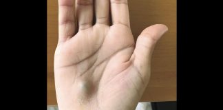 Canada guy finds bulging lump on his hand after dentist trip