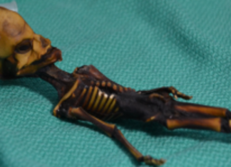 “Alien” skeleton found in Chile’s Atacama Desert actually human fetus with bone disorder