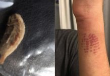Venomous caterpillar sends teen to emergency room with “the worst pain he ever felt” (Details)