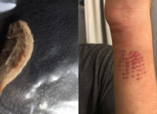 Venomous caterpillar sends teen to emergency room with “the worst pain he ever felt” (Details)