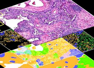 Study: Deep learning algorithm identifies tumor subtypes based on routine histological images Study: Deep learning algorithm identifies tumor subtypes based on routine histological images