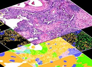 Study: Deep learning algorithm identifies tumor subtypes based on routine histological images