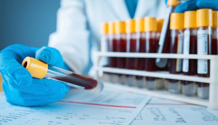 Study: Widely used blood test could advance heart failure treatment