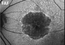 Study: Artificial intelligence recognizes deteriorating photoreceptors Study: Artificial intelligence recognizes deteriorating photoreceptors