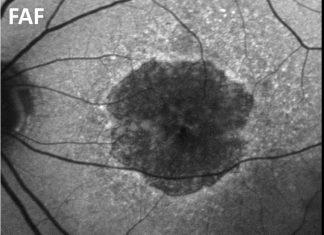 Study: Artificial intelligence recognizes deteriorating photoreceptors Study: Artificial intelligence recognizes deteriorating photoreceptors