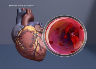 Study: New abdominal aortic aneurysm genes identified, could help pinpoint those at risk Study: New abdominal aortic aneurysm genes identified, could help pinpoint those at risk