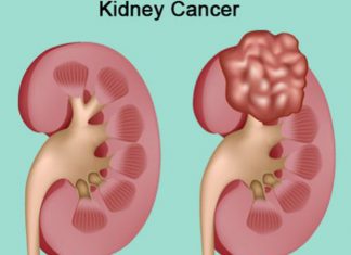 Study: New first-line treatment option for metastatic kidney cancer