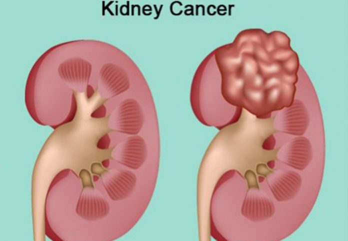 Study: New first-line treatment option for metastatic kidney cancer