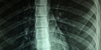Research: New artificial neural network detects radiographic sacroiliitis with accuracy